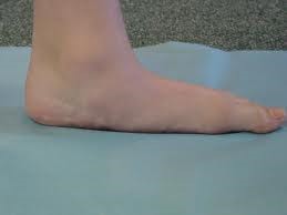 Arthritis1