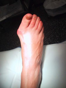 Arthritis2