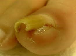 inGrowingTowNail2
