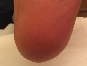After treatment of cracked heels