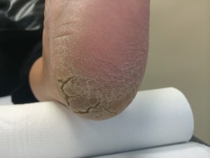 heel 1